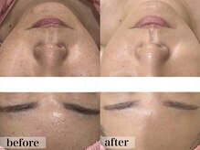 エステサロン ジョアアンジェ(joie ange)/イラストリアス　半年間