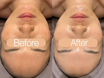 クレヴィア バイ サイバーエステ(CREBIA)/CHRISTINA【ハーブピーリング】