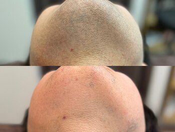 ボス 大曽根店(BOSS)/10回の脱毛効果です#ヒゲ脱毛