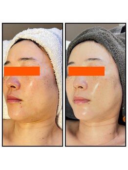 ピュアグレース 自由が丘/シミ　くすみ　鼻の黒ずみ解決☆