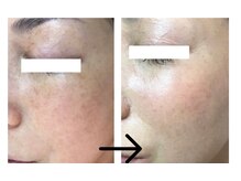 コトハ(cottha)/シャルムボー肌改善