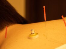 おさかべ鍼灸院/せんねん灸