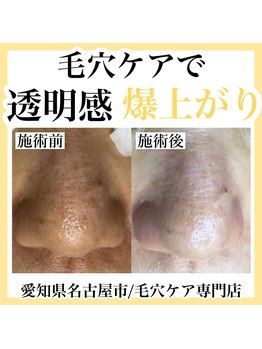 アモア(amoa)/毛穴ケア