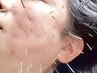  【究極小顔コース★】　 ルート鬼美容鍼　45分