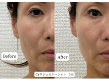 マテオ(Matteo)/CYリジュビネーション