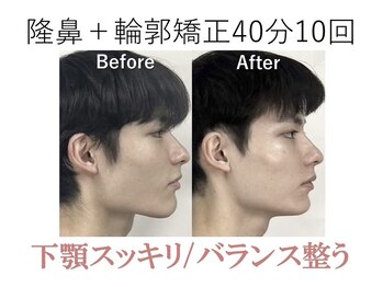ラプリ 大阪心斎橋店(Raplit)/隆鼻＋輪郭矯正40分10回