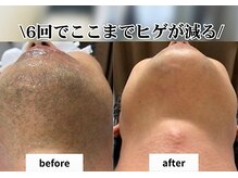 ノア(NOA.)の雰囲気（奈良初導入マシンで、剛毛:産毛効果◎/痛み軽減/最速仕上げ♪）