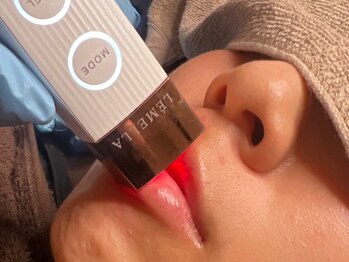 ジジベレッザ 大阪中崎町店(jiji belleza)/lamella(ルメラ)/コラーゲン生成