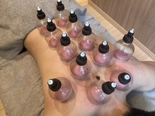 樹鍼灸整骨院/吸玉・カッピング