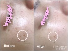 ラウレア(LAULEA)/シミケアBefore/after(4ヶ月)