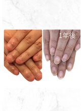 ティアラネイル 宇都宮/深爪矯正