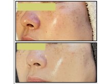 ピュアグレース 自由が丘/シミ　くすみ　鼻の黒ずみ解決☆