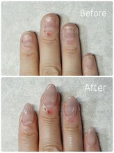 アウラ ネイル ファクトリー(aura nail factory)/深爪矯正スカルプ(長さだし)