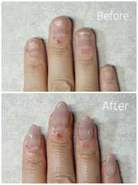 深爪矯正スカルプ(長さだし)