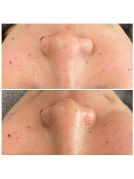 サロンピュア 所沢店/毛穴洗浄してすっきり♪