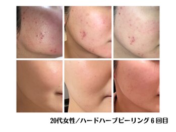 アイル(iru)/ハードハーブピーリング6回目