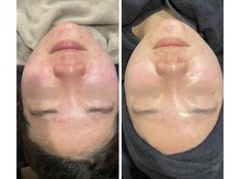 ニコリ(Nicori)/ハーブピーリング