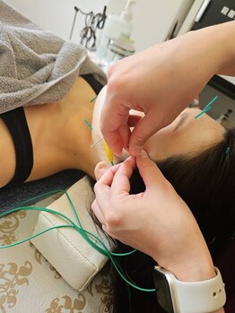 鍼灸整骨院ナガサキ(nagasaki)の写真/【首肩こり鍼灸&美容鍼♪】女性鍼灸師が行う美容鍼（頭+顔全体）¥4980★施術後の変化に感動!小顏効果も◎