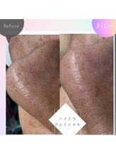 レチカ(Rechica)/毛穴洗浄ハイドラフェイシャル