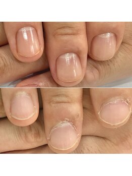 リファーレ(RIFARE)/【メンズ深爪矯正】30代男性