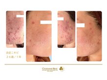 アティロン(Attirant)/【ニキビ改善】