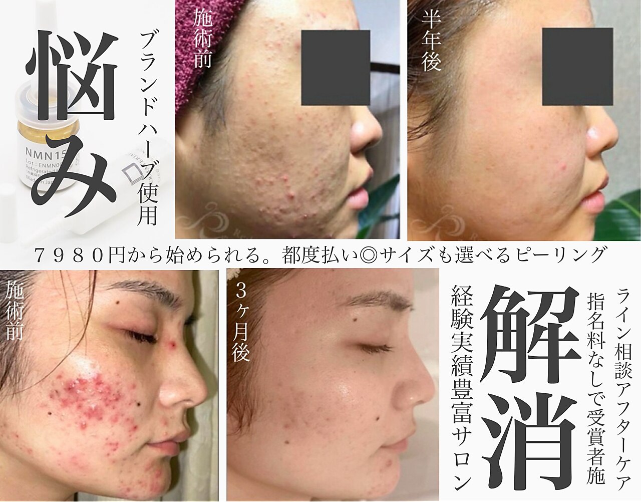 リベルハーブピーリング セット ハーブピーリング リベル 名古屋(Lebelle:)｜ホットペッパービューティー