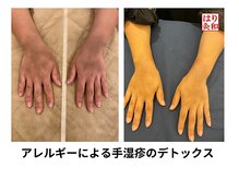 はりきゅう和 ルート鍼灸院/手湿疹のデトックス