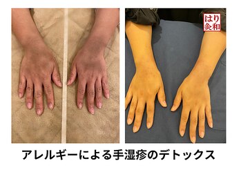 はりきゅう和 ルート鍼灸院/手湿疹のデトックス