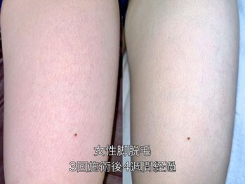 エクレ 柏店(EKURE)/レディース脚脱毛
