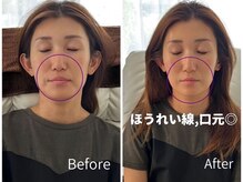 ミラ 中央林間(mira)/小顔　毛穴 ほうれい線 ハリ弾力