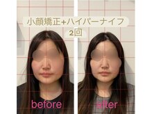 ビボーン ボディ(美bone body)/小顔矯正+ハイパーナイフ！
