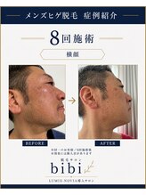 ビビ(bibi)/メンズヒゲ脱毛 施術8回
