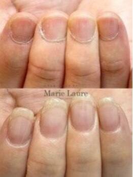 マリーロール 梅田店(Marie Laure)/自爪育成/深爪矯正/ネイルケア