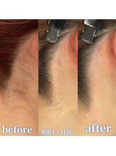 ダイア(DIA)/☆うなじ脱毛☆