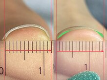 ルーナジェーナ(Luna llena)/【巻爪ケア】UPジェル