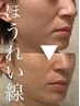 【悩み：キュッと小顔/二重アゴ解消】最上級水光＆小顔リフトアップ90分