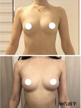 リール 新宿店(RIRE)/30代前半　バストアップ症例