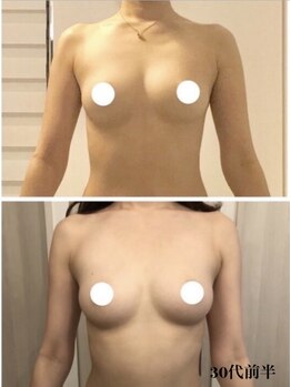 リール 新宿店(RIRE)/30代前半 バストアップ症例