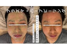 ジュエルオーキッド(Jewel orchids)/ハーブピーリング×プラズマ