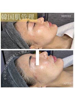 カルナ(CARNA)/スキンメイド１回施術施術前後