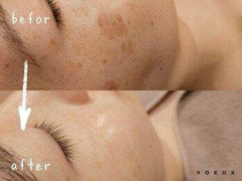 ボウ 名古屋店(VOEUX)/２０代　頬シミ　８回