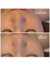 ブリス(BLiSS)/水素クレンジング＋美容液導入