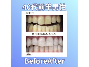 ホワイトニングショップ 西原店/40代前半男性☆BeforeAfter