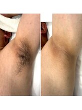 タスク(Tasuku.)/誰もが気になる脇脱毛