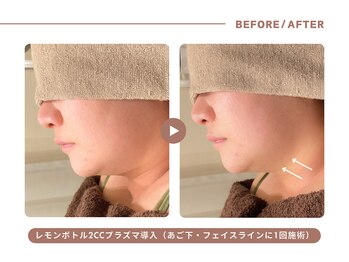 イエス マイサロン(yes My Salon)/レモンボトル施術例