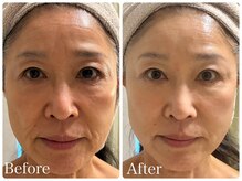 ロイヤル(ROYAL)/たるみ/シワ改善症例