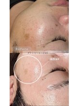 シュシュ(chouchou)/ダクトピールでシミ抜き