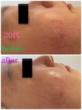 リヤン(Lien)/ニキビケアにもオススメ！