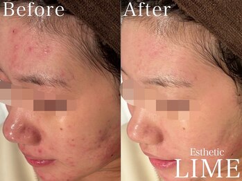 ライム 中野(LIME)/ハーブピーリング｜ニキビケア