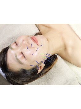 鍼灸施術を受けたい